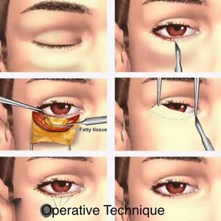 Blephroplasty…surgery for eye bags and sagging skin…#beautifuleyes#plasticsurgery #cosmeticsurgery #