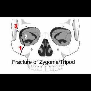 #plasticsurgery #maxillofacial_surgery #fracturemandible #blowoutorbitalfractures #facialinjuries #f
