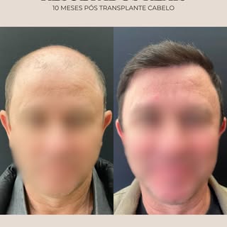 Dez meses de evolução após o transplante capilar.

Neste caso, o planejamento buscou reconstruir a l