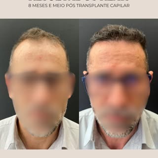 8 meses e meio de evolução após o transplante capilar.

Neste caso, o planejamento buscou melhorar a