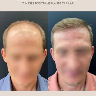 11 meses de evolução após o transplante capilar.

Neste caso, o planejamento buscou melhorar bioober