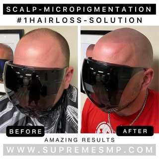 We offer the #1 hair loss solution available today: Scalp Micropigmentation. Whether you’re looking 