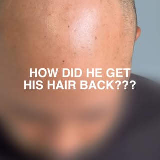 Scalp Micropigmentation (SMP) offers a powerful, non-surgical solution that can restore the appearan