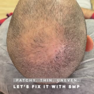 Balding in all the wrong places? Let’s bring some balance back! 

Hair Loss Solution for Men & Women