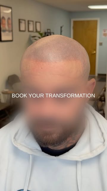 Hair Loss Solution for Men & Women | Scalp Micropigmentation (SMP)
Struggling with hair loss, thinni