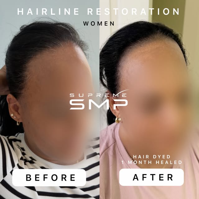 The goal with this treatment was to reduce the appearance of forehead space and create a softer, mor