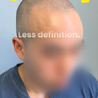 SMP restores the appearance of density and creates the illusion of a stronger, fuller hairline, with