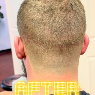 Scar Concealment. Seamless Results.

FUT transplant scar? SMP can help blend the appearance of the s