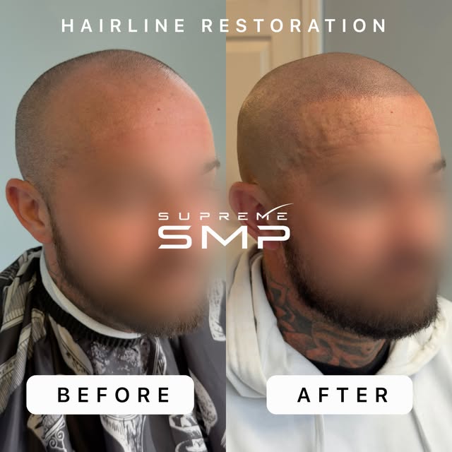In the market for a new hairline? There’s no better time than NOW. 🔥☘️🥊 👑 

Take a look at this t