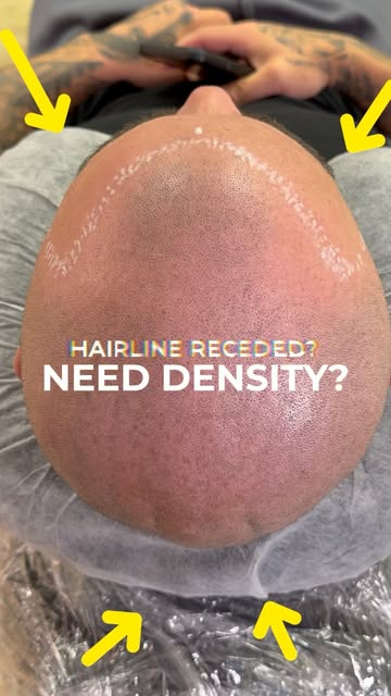 From rebuilding a natural looking hairline to adding density where you need it most, the goal is sim