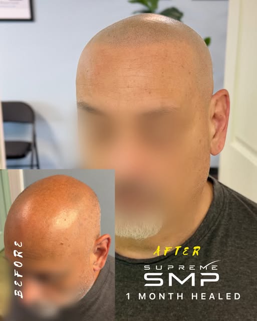 One month healed. Three sessions. One exceptional transformation.

The finished result speaks for it