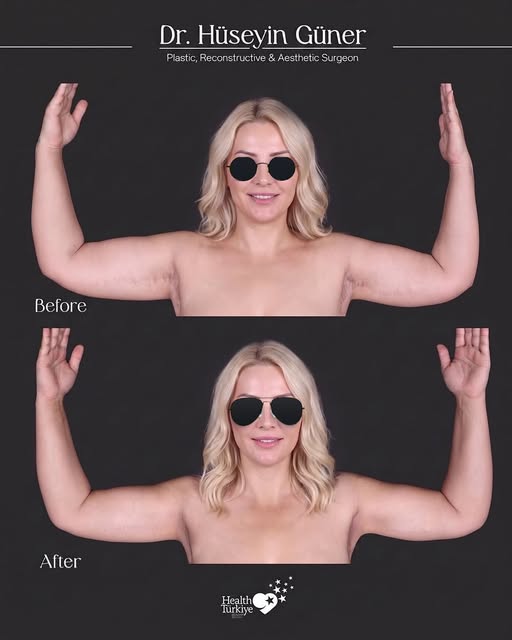 Long-Term Arm Liposuction Results ✨ | 2023 → 2025

Our patient came to us after previously undergoin