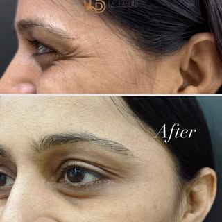 Botox (botulinum toxin) treatment temporarily relaxes targeted muscles to reduce the appearance of d