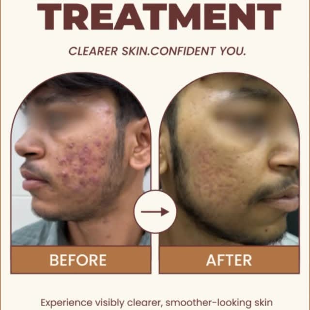 From Acne Breakouts to Happier Skin! 

Acne can affect more than just your skin—it can affect your c