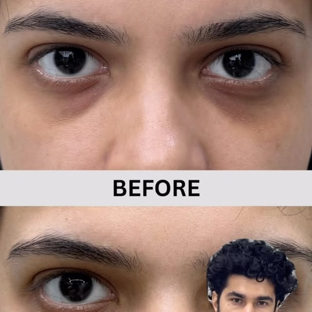 Refresh your eyes, smooth your forehead, and retain your natural expression—all in one session.
​As 