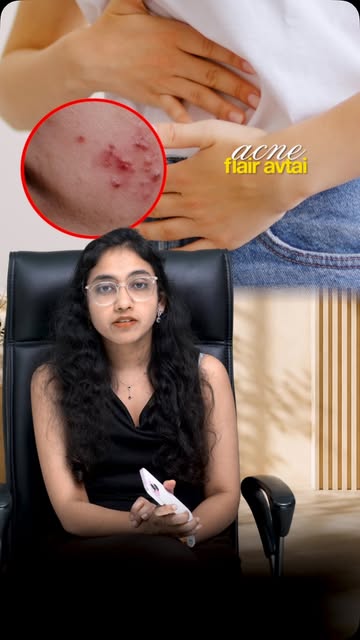Periods and pimples, aren’t they always a pair??
Services: Pediatric dermatology, fungal infections 