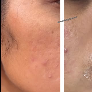 Before after Acne journey.  #instadaily #instagood #follow #photography #trending