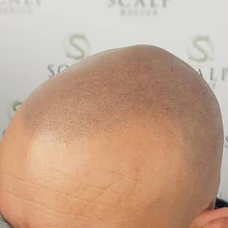 HEALED RESULTS. It is very important to see what scalp micropigmentation looks like months after hea