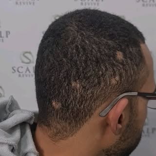 Childhood scaring from ring worm. A very popular scar covering with scalp micropigmentation. He deci