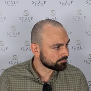 Insant results. Minimal pain, no regret. #scalprevive #scalp micropigmentation #smp #hairloss #leeds
