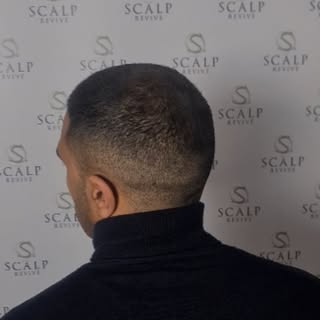 Crown density 1/3 session
 Scalp micropigmentation is an amazing solution for thinning hair.