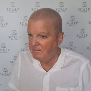 This is a full head smp healed results of 5 years coming in for a top up. With a requested peak and 