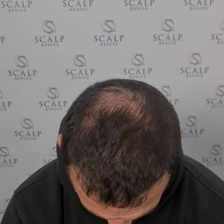 Scalp micropigmentation added to a hair transplant. This is what the 1st session looks like. #scalpr