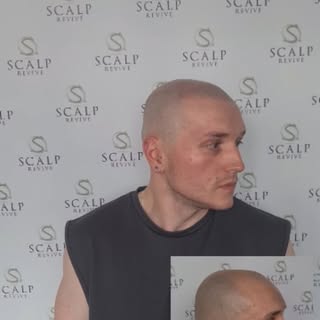 Scalp Micro Pigmentation Leeds 
www.scalprevive.co.uk