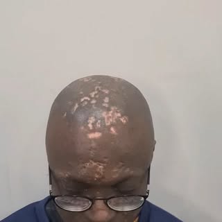 Life changing Scar Camouflage for Lupus scarring. 
... If I can't do it.. it can't be done. 🙌🏽 
Co