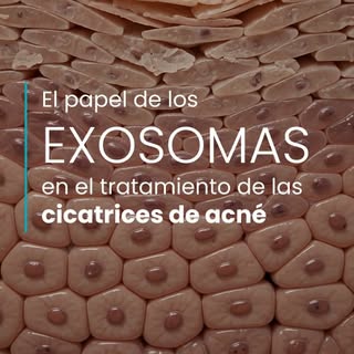 Muchas veces el acné activo desaparece, pero las marcas se quedan durante años. Y no, no todas son i
