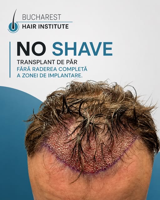 Tehnica No Shave permite realizarea transplantului de păr fără a tunde zona pretabilă transplantului