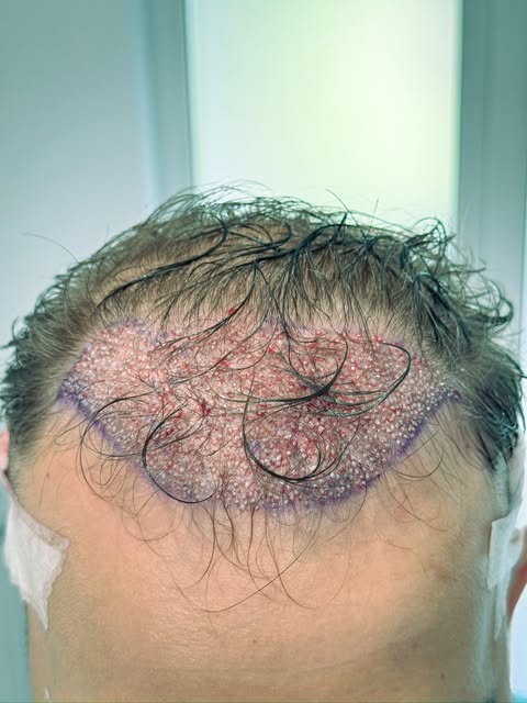 Un transplant de păr reușit începe cu atenția acordată fiecărui detaliu.

În tehnica No Shave partia