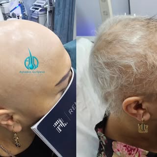 10 il uzun bir müddətdir və total alopesiya (Alopecia Totalis) həm fiziki, həm də psixoloji baxımdan