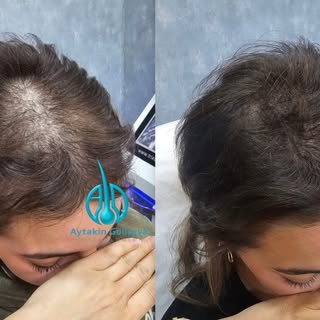 Saç tökülməsi, qırılmalar və ya cansız görünüş... Bunlar sadəcə estetik problem deyil, saçlarınızın 