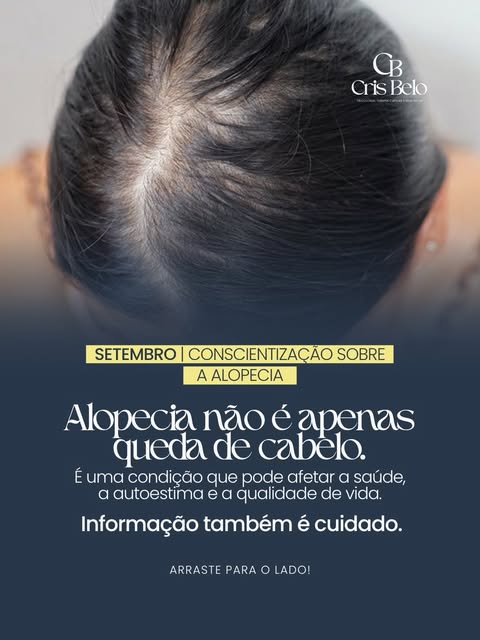 Alopecia não é apenas sobre perder cabelo.
Ela pode afetar a autoestima, a saúde emocional e a quali