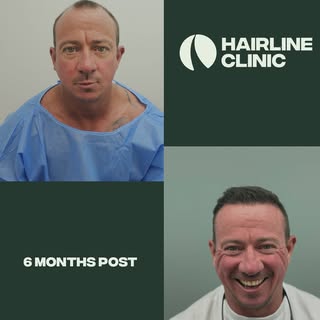 6 months between images 6,100 grafts

Dr Rukshan Senanayake
Medical Practitioner (General Registrati