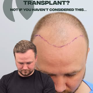 You’re not ready for a hair transplant if you haven’t thought about the long game.

Disclaimer: Indi