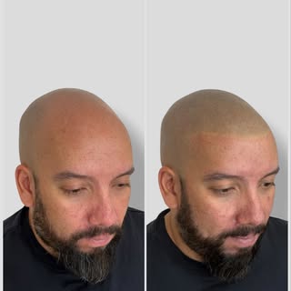 When it comes to Scalp Micropigmentation, less is often more. 

Ask your SMP person for subtle, soft