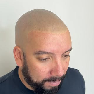 Three sessions of Scalp Micropigmentation later and your hairline can be restored. Instant results t