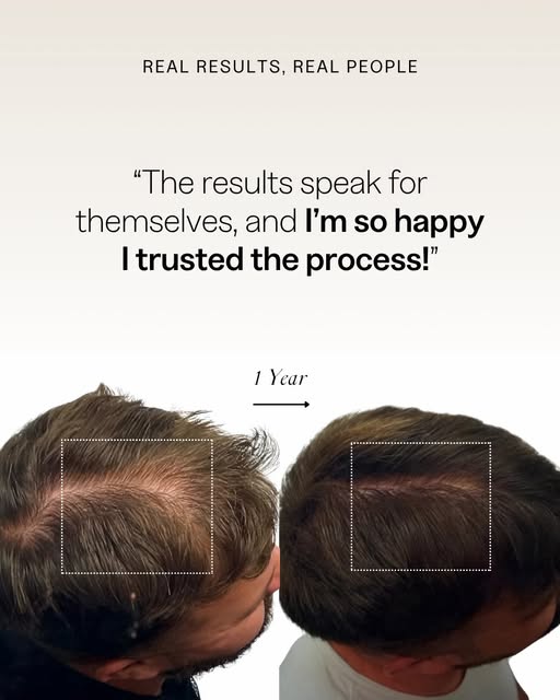 “I no longer have the worries about hair loss that plagued me for years.”

That’s the NHLMA differen