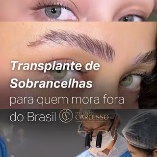 Do you live outside Brazil and dream of getting an eyebrow transplant? 🌍✈️

We have welcomed patien