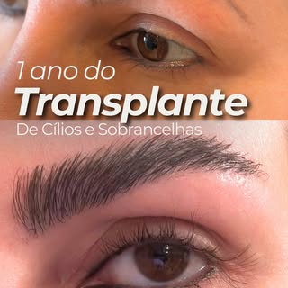 Essa paciente apresentava uma perda significativa dos fios das sobrancelhas e também dos cílios. Apó