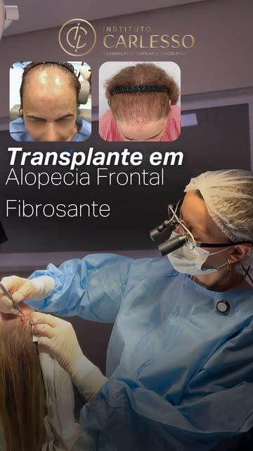 No Instituto Carlesso, associamos o transplante capilat em Alopecia Frontal Fibrosante às terapias r