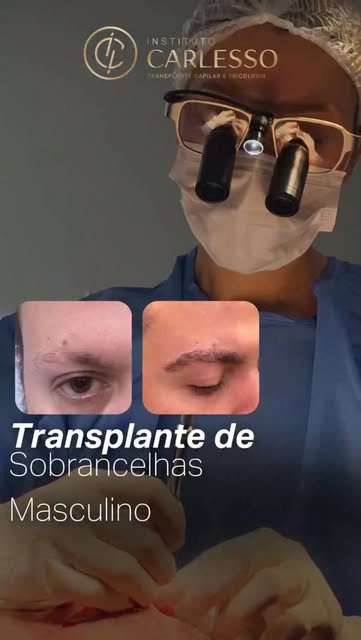 O transplante de sobrancelhas também é para homens e essa procura tem crescido cada vez mais.

Seja 