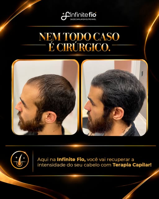 Nem todo caso de queda ou afinamento capilar precisa de cirurgia.

Quando ainda existem folículos vi