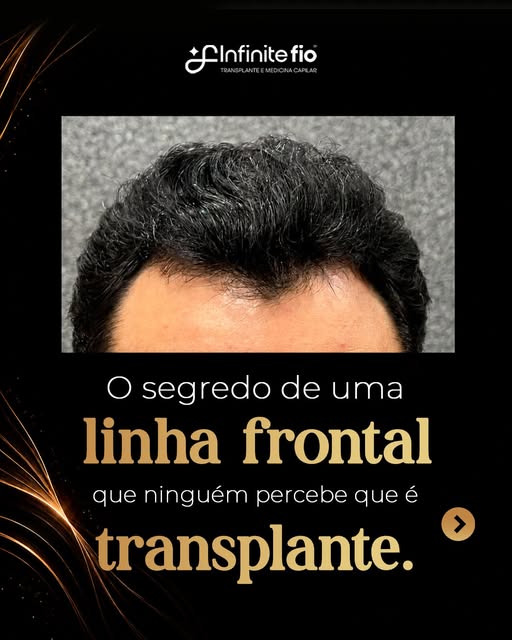 Uma linha frontal bem planejada não chama atenção para o transplante. **Ela simplesmente parece pert