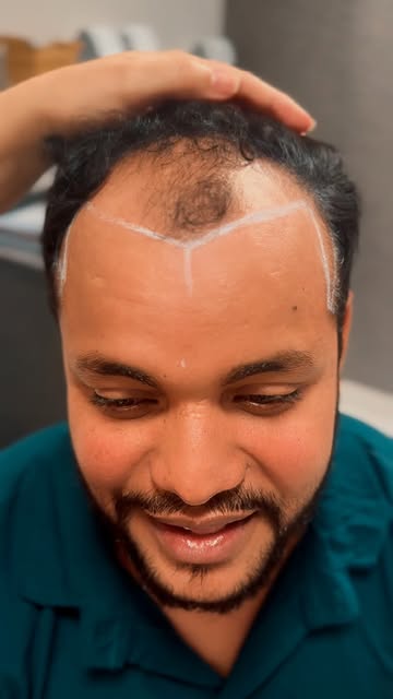 Acompanhem o caso do Adriando que está realizando hoje a Cirurgia de Transplante Capilar FUE e deixa