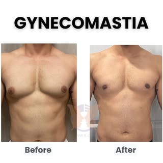 💪 36-Year-Old Bodybuilder’s Transformation

Gynecomastia caused by steroid use can’t be fixed with 