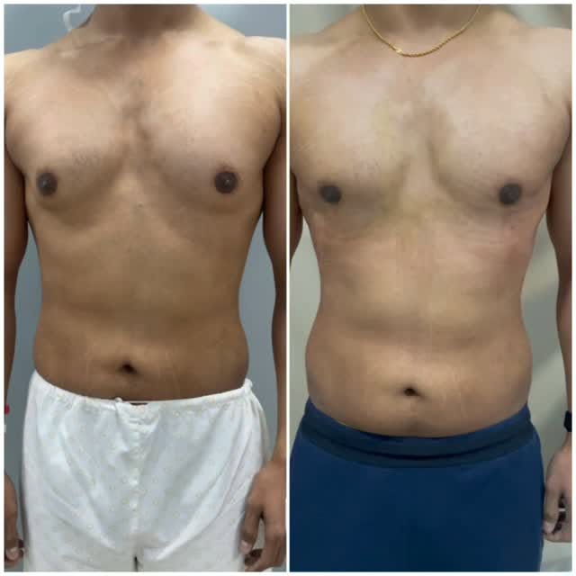 ✨ 𝐆𝐲𝐧𝐞𝐜𝐨𝐦𝐚𝐬𝐭𝐢𝐚 𝐒𝐮𝐫𝐠𝐞𝐫𝐲: 𝐁𝐞𝐟𝐨𝐫𝐞 & 𝐀𝐟𝐭𝐞𝐫

Gynecomastia can affect the sh