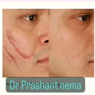 #advance scar treatment # Scar revision # post trauma scar treatment#acne scar treatment #facial sca